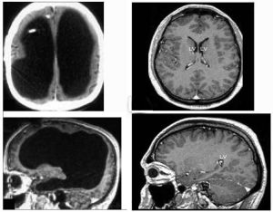 한 남성 뇌의 90%가 손상 됨 - The Lancet, Feuillet et al