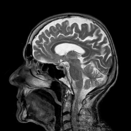뇌와 의식 - MRI