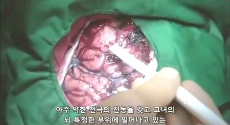 베리칩과 뇌 - 약한 전극으로 뇌를 자극