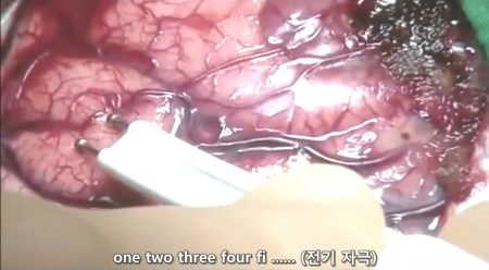 베리칩과 뇌 - 약한 전극으로 뇌를 자극하면 숫자를 세지 못함