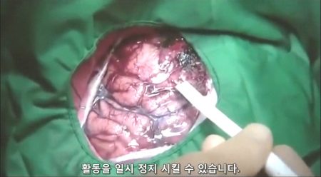 베리칩과 뇌 - 약한 전극으로 뇌를 자극해서 일시 정지 시킬 수 있다